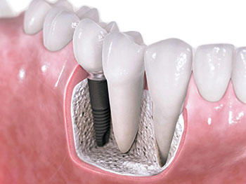 Cirurgia - Foto de um dente implantado cirurgicamente
