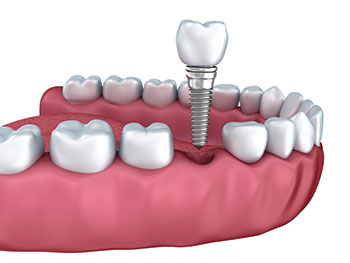 Implantes - Exemplo de um implante dentario
