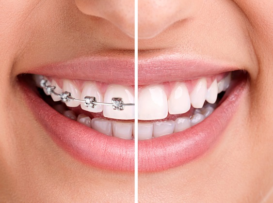 Aparelho ortodôntico - Foto de metade dos dentes com aparelho ortodôntico